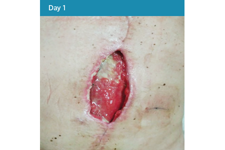 12. Dehisced Abdominal Wound Case Study - Day 1.png