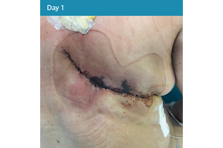 14. Closed Surgical Incision - Day 1.png