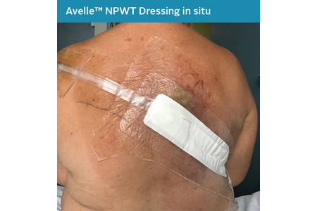 15. Closed Surgical Incision - NPWT in situ.png