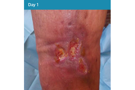 17. Mixed Aetiology Leg Ulcer Case Study - Day 1.png