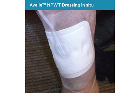 18. Mixed Aetiology Leg Ulcer Case Study - NPWT in situ.png